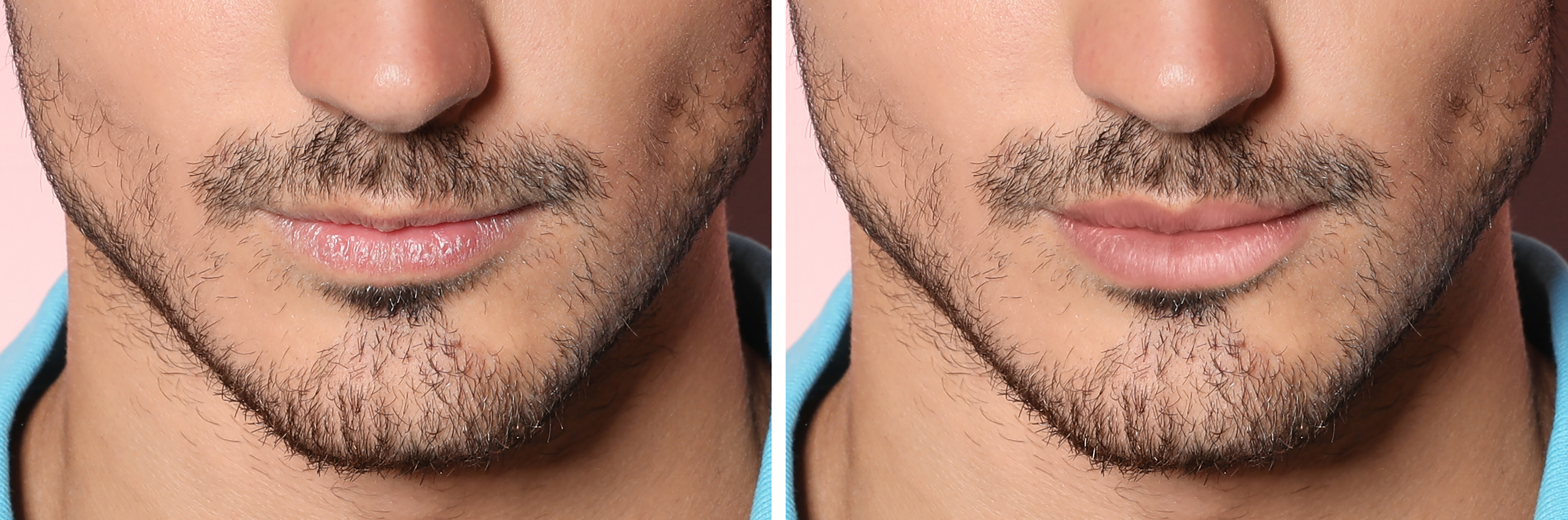 liplift bij heren liplift bij heren